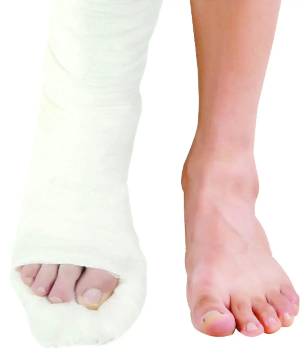 Top Cast Plaster Of Paris Bandage Bp 15 X 2.7M (Pack Of 12) By Dynamic Techno Medicals 1